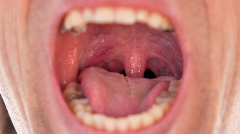 palmon's uvula